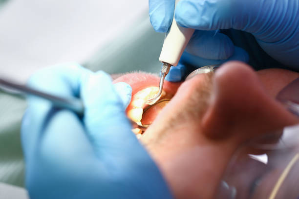 Best Emergency Wisdom Teeth Removal in Fabrica, TX